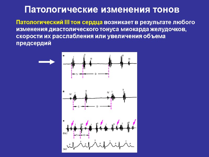 Патологический III тон сердца возникает в результате любого изменения диастолического тонуса миокарда желудочков, скорости